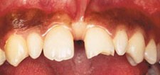 Figure 1. Melanin hyperpigmented gingiva