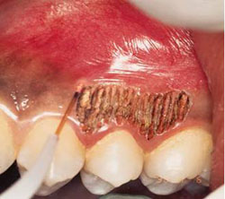 Figure 2. Gingivoplasty using a laser