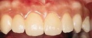 Figure 4. Final result after orthodontic and restorative treatment