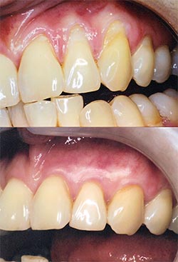 Connective tissue graft (CTG) Procedure