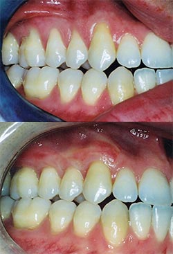 Connective tissue graft (CTG) Procedure