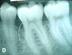 Post-surgical view of periodontal defects repaired with the combination of bone graft and barrier membrane