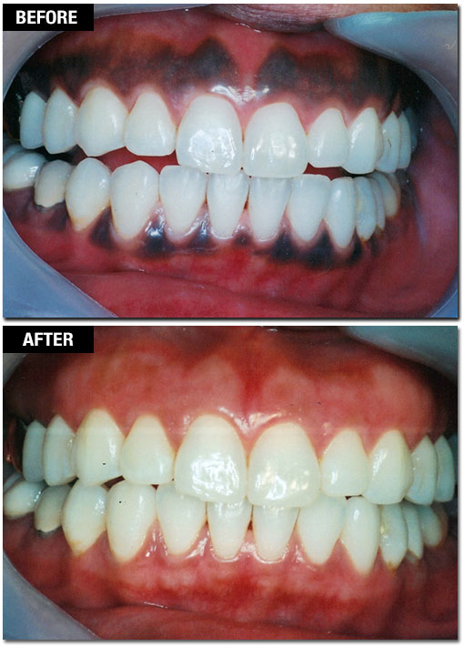 Laser Gum Pigmentation Removal - Before and After