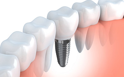 Dental Implants