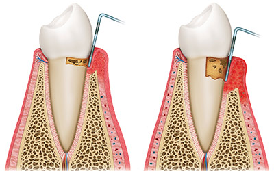 Periodontal (Gum Disease) Therapy