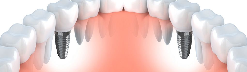 Dental Implants