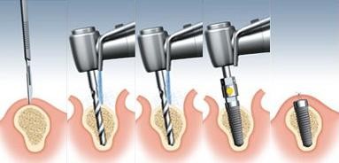 Implant Placement