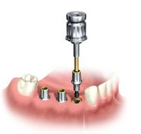 Dental Implants Restoration