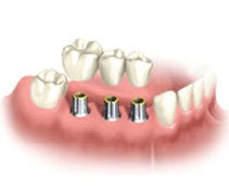 Dental Implants Restoration