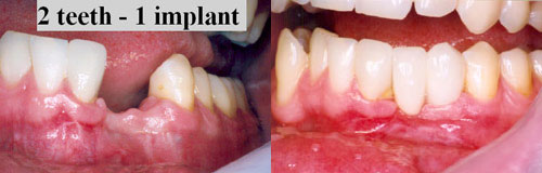 2 Teeth with 1 Implant