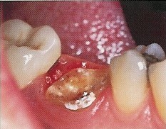 Periodontal (Gum Disease) Therapy - Crown Lengthening Surgery