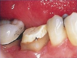 Periodontal (Gum Disease) Therapy - Crown Lengthening Surgery