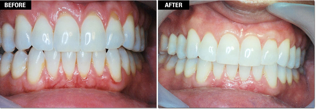 Smile Enhancement - Gum Grafting/Receding Gums Treatment