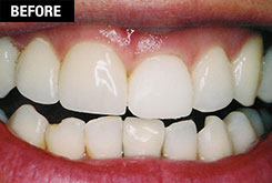 Smile Enhancement - Cosmetic Laser Gum Surgery