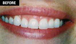 Smile Enhancement - Cosmetic Laser Gum Surgery