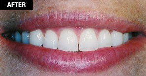 Smile Enhancement - Cosmetic Laser Gum Surgery