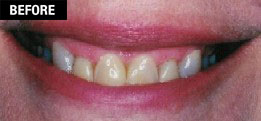 Smile Enhancement - Cosmetic Laser Gum Surgery