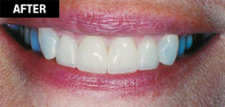 Smile Enhancement - Cosmetic Laser Gum Surgery