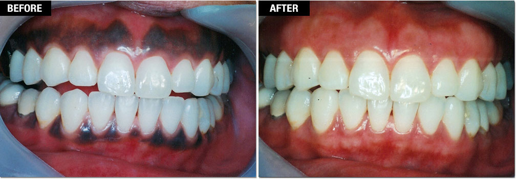 Smile Enhancement - Laser Gum Pigmentation Removal